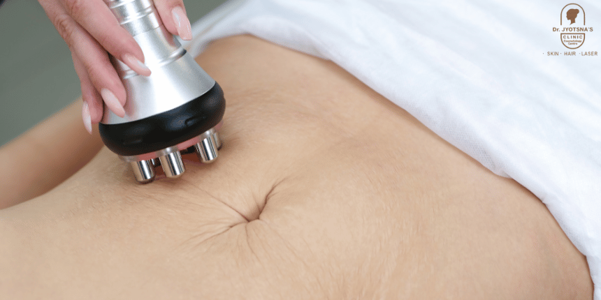 Stretch Mark Reduction Treatment