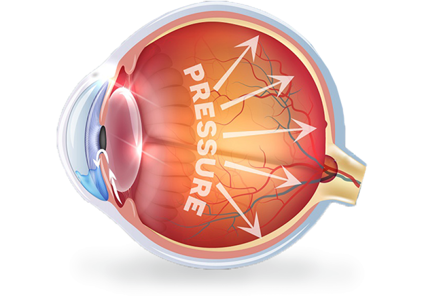 Glaucoma Surgery in Gujarat: A Comprehensive Guide for Patients