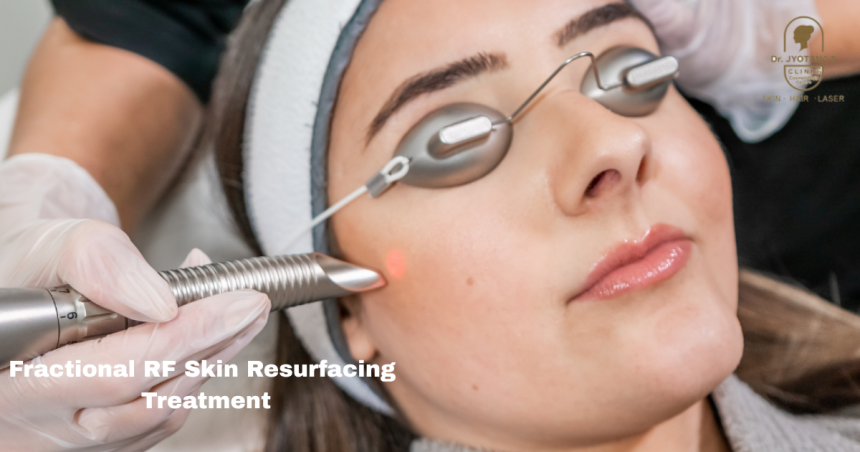 Fractional RF Skin Resurfacing Treatment