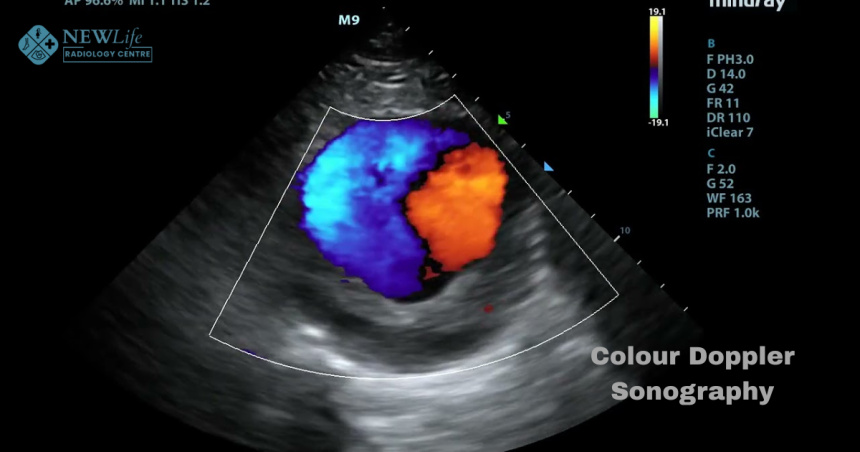 All You Need to Know About Colour Doppler Sonography in Thane – A Simple Guide by New Life Radiology Clinic