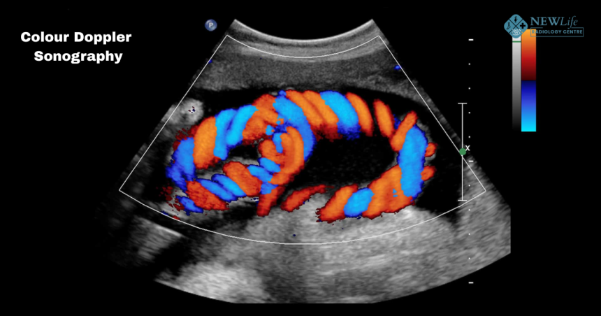 What is Colour Doppler Sonography and Why Is It Done?  By Dr. Harish Pawar – A Trusted Radiologist in Thane