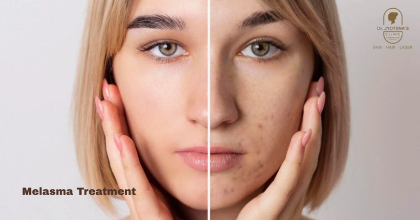 Melasma Treatment