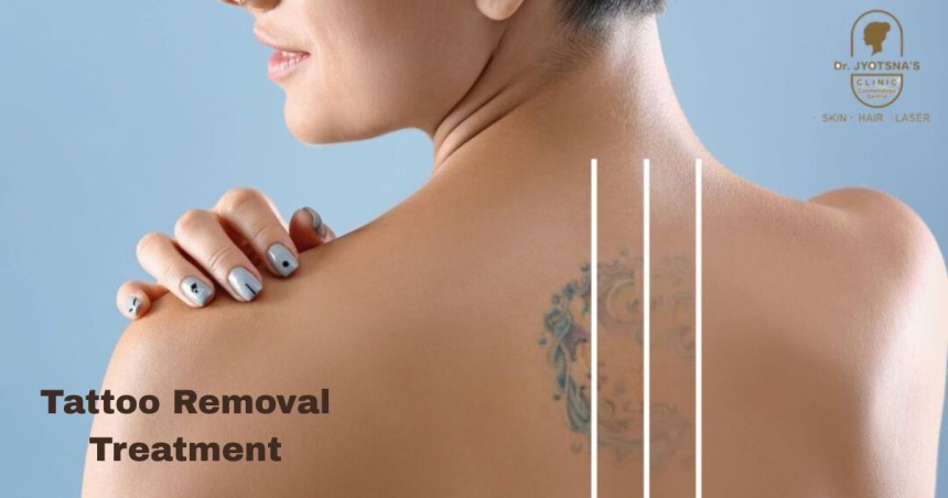 Tattoo Removal Treatment in Thane Myths vs Reality