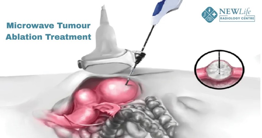 Microwave Tumour Ablation Treatment